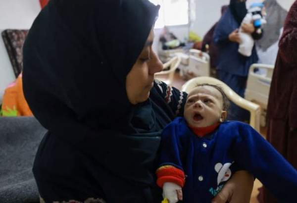 Gaza hospital records 50 children admitted over malnourishment