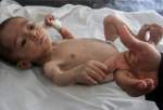 UN warns against repercussions of malnutrition on pregnant women, newborns in Gaza