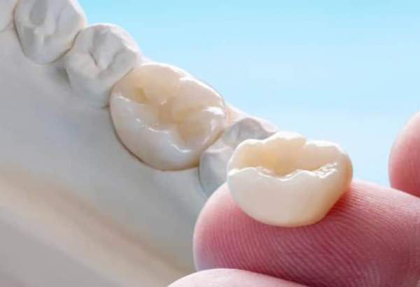 چرا هزینه روکش دندان متفاوت است؟