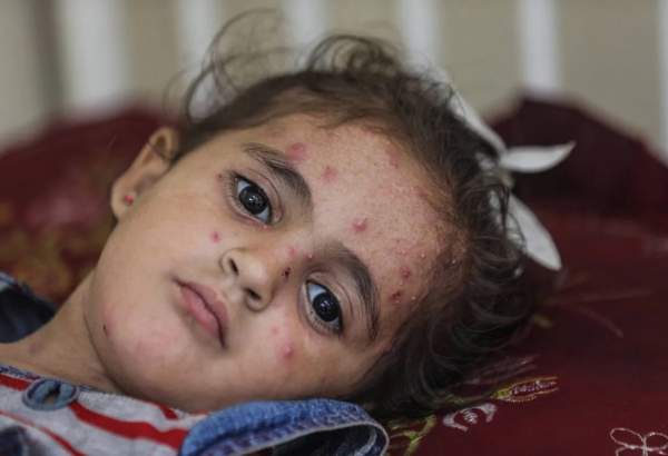 Palestinian children plagued by infectious skin diseases in Gaza