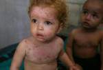 Skin diseases plague Palestinian children suffering Israeli onslaughts in besieged Gaza (photo)  