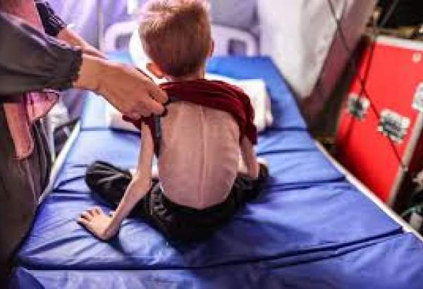 WHO warns against severe malnutrition challenging children in Gaza